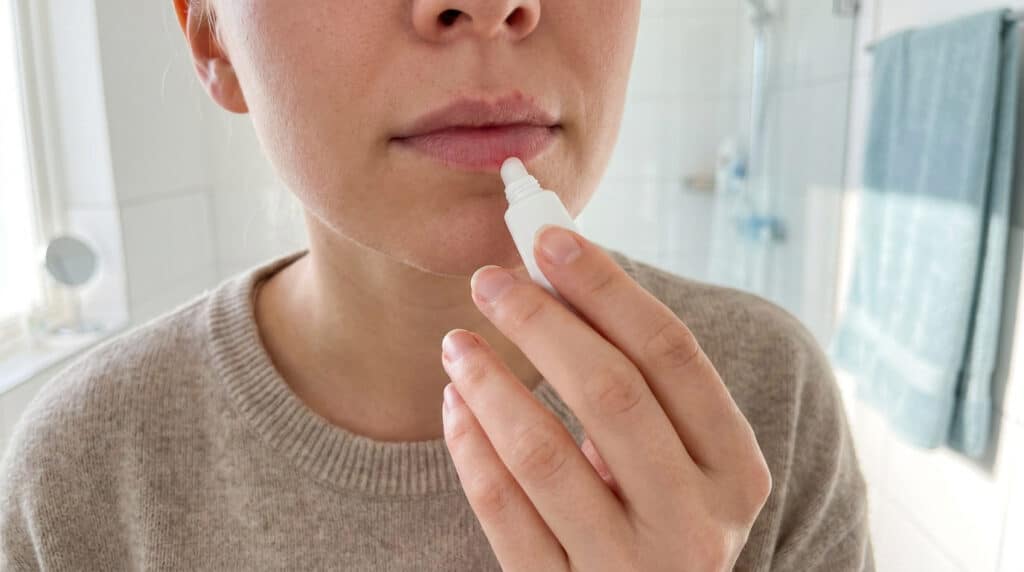 Une femme applique une crème sur une lésion d'herpès labial sur ses lèvres.
